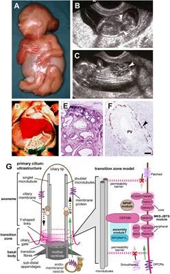 Meckel–Gruber Syndrome: An Update on Diagnosis, Clinical Management, and Research Advances